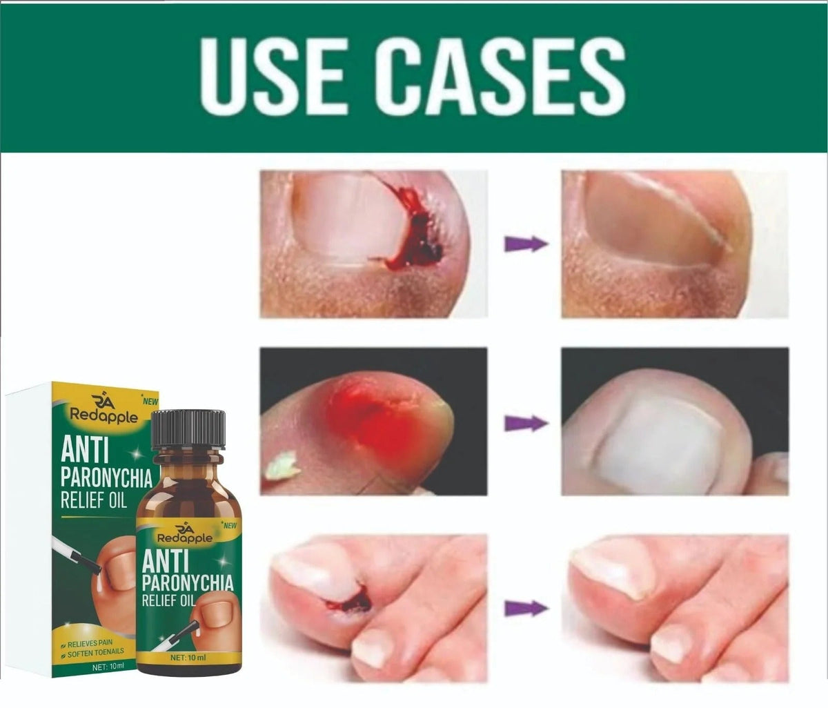 Anti Paronychia Relief Oil : Buy 1 Get 1 Free