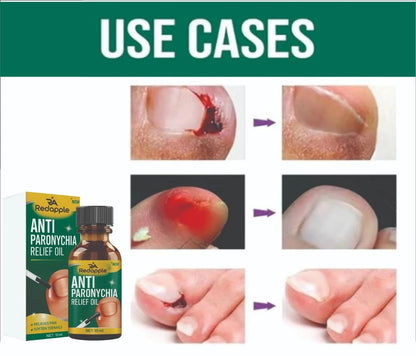 Anti Paronychia Relief Oil : Buy 1 Get 1 Free