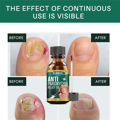 Anti Paronychia Relief Oil : Buy 1 Get 1 Free